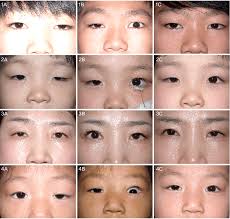 Photographs of patient 1 (1A-1C), 2 (2A-2C), 3 (3A-3C) and 4 (4A-4C)....
