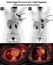 · are there any vaccinations for cancer? Metabolic Characterization Of Inflammatory Breast Cancer With Baseline Fdg Pet Ct Relationship With Pathologic Response After Neoadjuvant Chemotherapy Receptor Status And Tumor Grade Clinical Breast Cancer