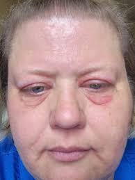 Has anyone else been allergic to epoxy resin?