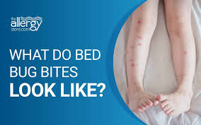 Image result for bedbug bites look like