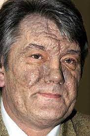 Jun 27, 2021 · dioxinvergiftung politiker. Dioxin Vergiftung Mediziner Halt Juschtschenko Fur Suizidgefahrdet Der Spiegel