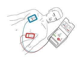 Alibaba.com offers 991 paddle defibrillator products. Unresponsive And Abnormal Breathing When A Defibrillator Is Available Global First Aid Platform