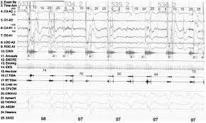 See 3,534 tripadvisor traveller reviews of 117 port dickson restaurants and search by cuisine, price, location, and more. Sleep Breathing And Neurologic Disorders Springerlink