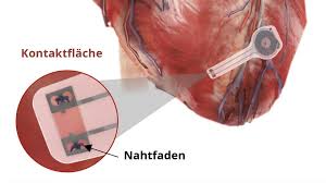 Bund und länder müssten sich zeitnah darauf verständigen, wann und wo welche maßstäbe für weitere einschränkungen im herbst gelten sollen. Herzschrittmacher Lost Sich Auf Wenn Er Nicht Mehr Gebraucht Wird Mdr De
