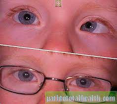 Saraf ini penting agar kita dapat menentukan bagaimana bentuk suatu benda yang kita lihat. Amblyopia Refraktif Gejala Darjah Diagnostik Yang Diperlukan Pilihan Rawatan Nasihat Pakar Mata Penglihatan 2021