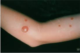 Image result for Impetigo