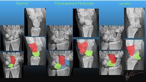 Image result for Lunate Dislocation