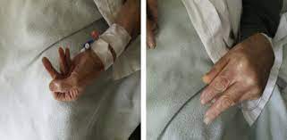 While its cause is not fully understood. Guillain Barre Syndrome Related To Nivolumab Case Report Of A Patient With Urothelial Cancer And Review Of The Literature Clinical Genitourinary Cancer