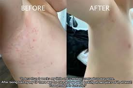 What does molluscum look like when healing. Molluscum Contagiosum Children 219 Testimonials A Medical Doctor S Guide To Wheatgrass Healing