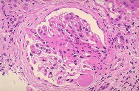 The hallmark of ms is. Resultado De Imagen Para Glomeruloesclerosis Mesangial Difusa Histologia