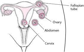 Take a breath and slow down. Ectopic Pregnancy Women S Health Issues Msd Manual Consumer Version
