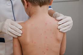 25 years' experience with the biken oka strain varicella vaccine: The Varicella Zoster Virus Viro Research