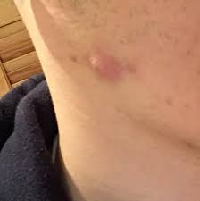Ist Das Nun Eine Verstopfte Talgdruse Ein Lipom Oder Etwas Ganz Anderes Medizin Arzt Krankheit