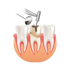 Ilustracao Sobre Limpe A Carie Pela Broca Dental Do Dente Ilustracao Realistica Do Vetor 3d De Cuidados Medicos Root Canal Treatment Root Canal Dental Cavities