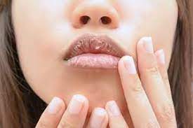 Hausmittel Gegen Trockene Lippen Was Hilft Schnelle Hilfe Und Alternative Heilmittel Krank De