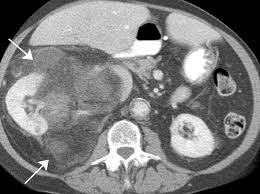 Image result for Perinephric Abscess