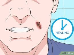Larger, deeper wounds may take 2 weeks or longer for the wound to heal completely and the scab to disappear. How To Heal Scabs On Your Face 9 Steps With Pictures Wikihow