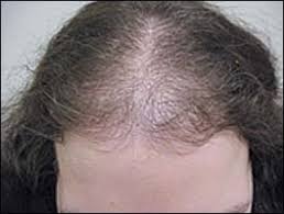 The autoimmune disease known as alopecia areata is also an umbrella term that encompasses the other forms like alopecia totalis, alopecia universalis. Common Hair Loss Disorders American Family Physician