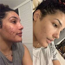 Epiduo antes y después de 6 meses. ¡Mejora! : r/acne