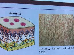 How to tell the difference Vascular Skin Lesions Flashcards Quizlet