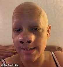 Diagnosis is based on clinical manifestations and history take a picture of the nasal cavity and paranasal sinuses. Mother Battles Skin Cancer That Forced Doctors To Remove Her Nose But She Is Hoping To Get Married Daily Mail Online