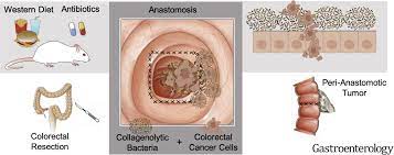 Western Diet Promotes Intestinal Colonization By Collagenolytic Microbes And Promotes Tumor Formation After Colorectal Surgery Gastroenterology