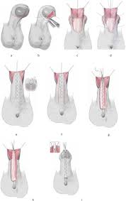 Image result for Chordee