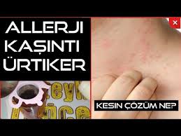 Cilt Alerjisi Nedir Youtube