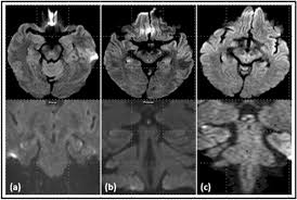 Image result for Transient Global Amnesia