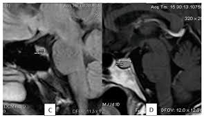 Pituitary Gland - Physiopedia