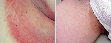Image result for sore skin in the groin area