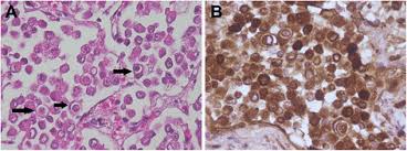 Cytology tests often look for large balls of cells that resemble the structure of a berry. Four Cases Of Cell Cannibalism In Highly Malignant Feline And Canine Tumors Diagnostic Pathology Full Text