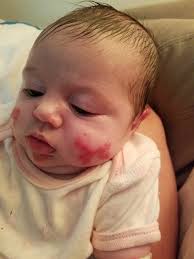 Heartbreaking: Parents Can't Hold Baby For Fear Her Skin Will Come Off