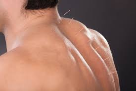 Myofascial Pain What Is The Best Treatment