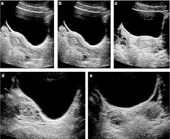 Maybe you would like to learn more about one of these? Normative Values For Ultrasound Measurements Of The Female Pelvic Organs Throughout Childhood And Adolescence Semantic Scholar