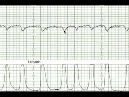Image result for Early Deceleration