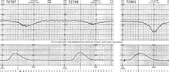 Image result for Late Deceleration