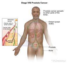 The pancreas is located behind the stomach, so having pancreatic cancer doesn't involve a palpable mass that you can feel. Prostate Cancer Treatment Pdq Patient Version National Cancer Institute