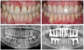 Rebuilding Bone Loss In Gums Blog Advanced Dentistry