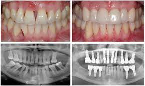 Normally, the bone surrounding the tooth roots provides a strong, stable base. Rebuilding Bone Loss In Gums Blog Advanced Dentistry