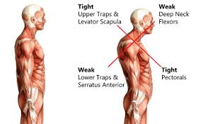 These types of back injuries often occur due to a sudden or unexpected movement of the upper body, especially when lifting. Poor Posture Can Lead To A Painful Muscle Deformity Over Time