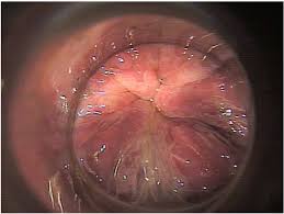 Image result for Anoscopy