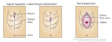 vajinal yapisiklik labial fuzyon dr yilmaz bay