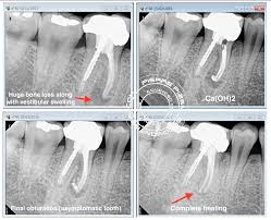 It can also protect the tooth from future. Selective Root Canal Retreatment Endomontreal