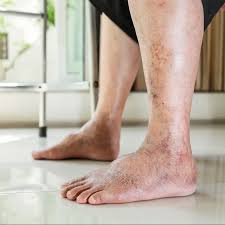 Image result for black toe diabetes