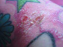 How To Treat An Infected Tattoo And Tattoo Ink Allergy Tattoo Ink Allergy Infected Tattoo Allergic Reaction To Tattoo
