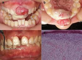 Image result for granuloma gum disease