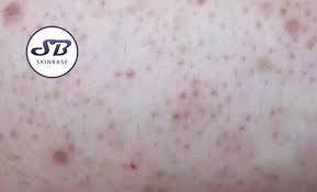 Image result for Keratosis pilaris