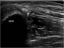 Lateral femoral cutaneous nerve block ultrasound. Ultrasound Of The Lateral Femoral Cutaneous Nerve In Asymptomatic Adults Bmc Musculoskeletal Disorders Full Text