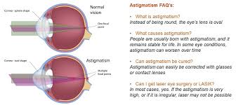 Astigmatism The Eye Practice The Eye Practice